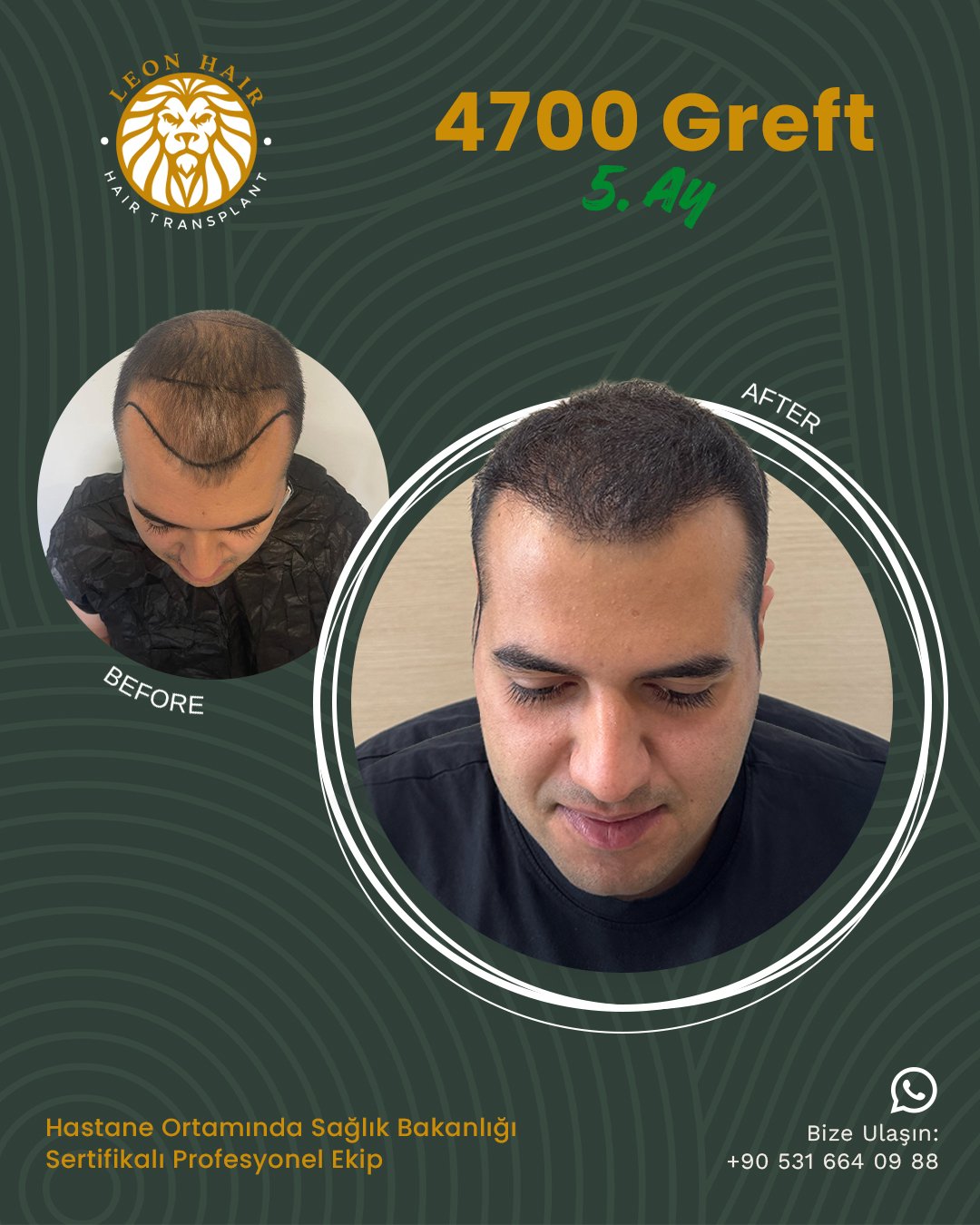 Ön Saç Çizgisi & Şakak Restorasyonu