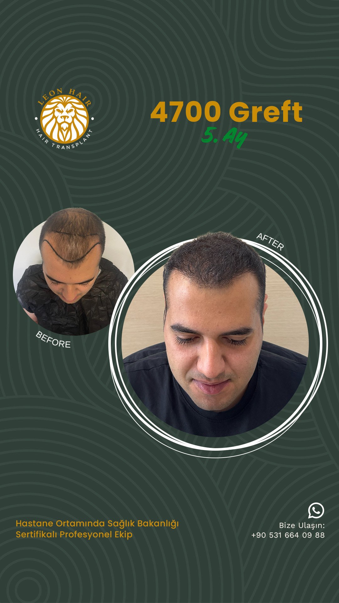 @leonhairtransplant story 1
