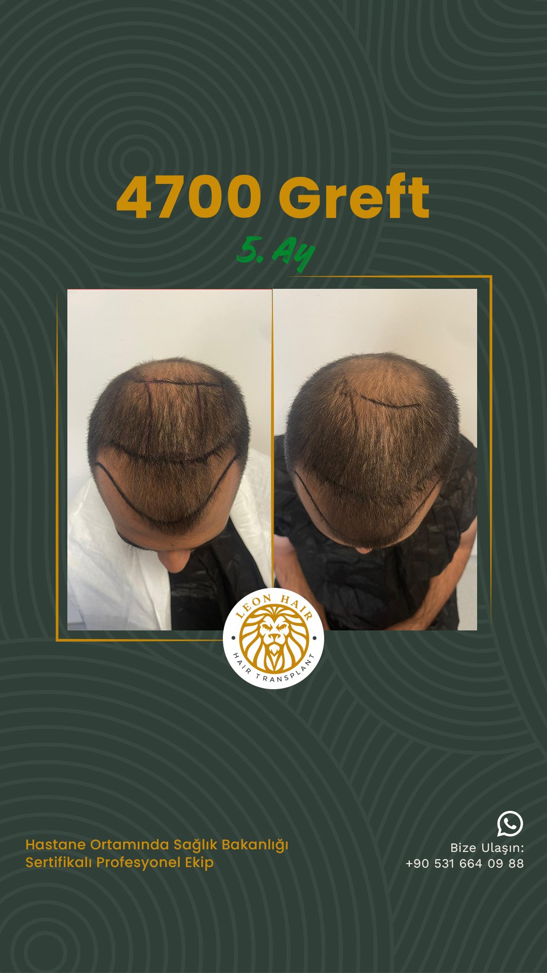 @leonhairtransplant story 2