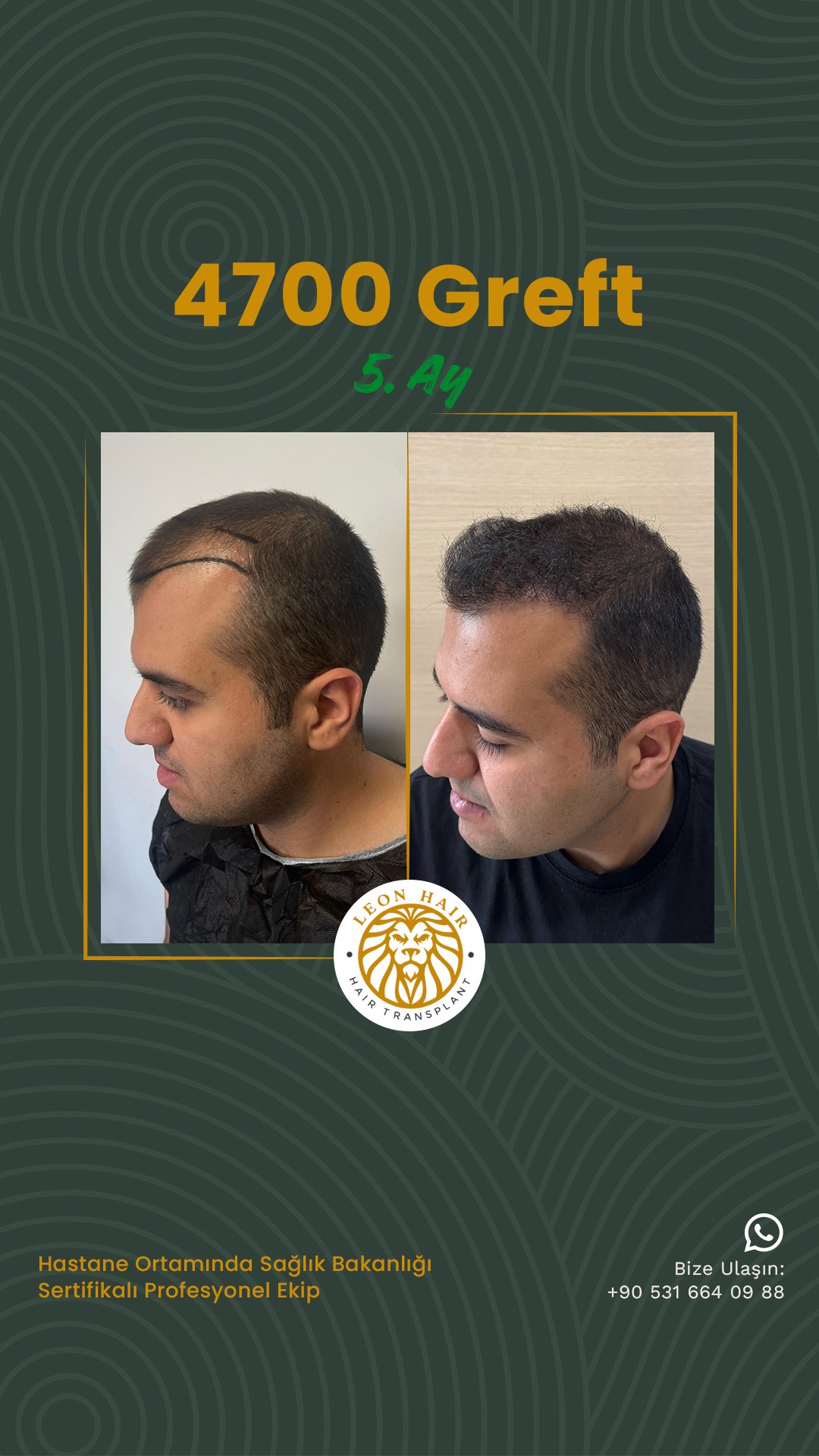 @leonhairtransplant story 3